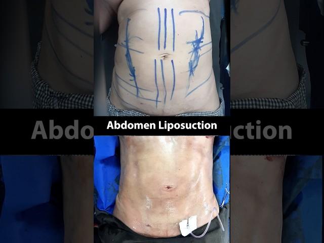 Abdomen Liposuction Before and After! On Table Result 2024 #shortsfeed