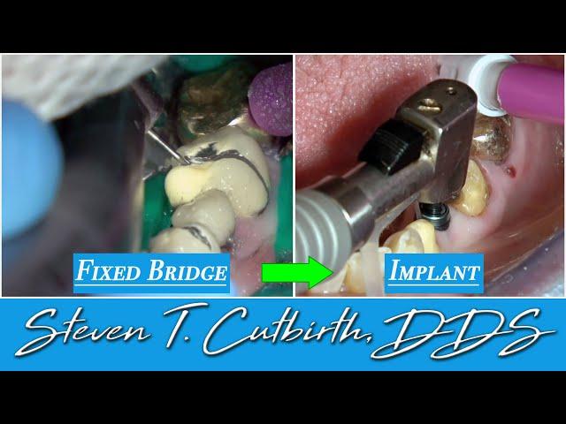 Implant Placement After Removing Fixed Dental Bridge - Dental Minute with Steven T. Cutbirth, DDS