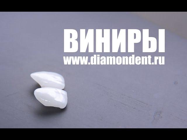 Виниры на зубы плюсы и минусы. Мнение эксперта!