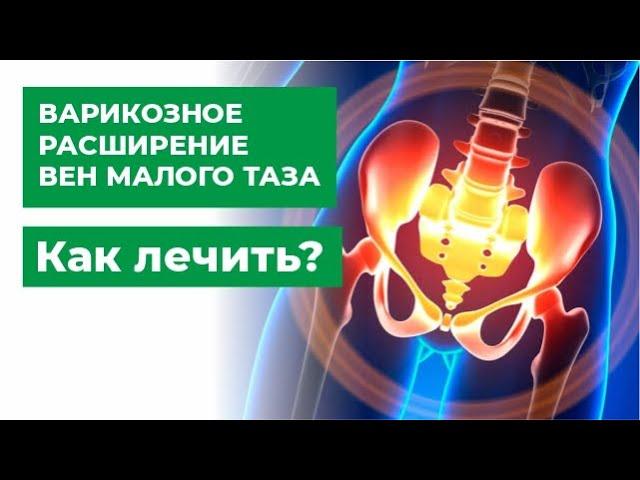 Варикоз малого таза | Синдром хронической тазовой боли