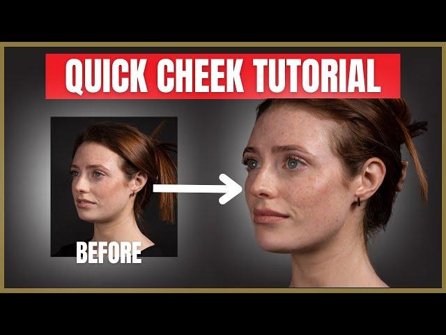 Quick Cheek Filler Tutorial | Cheek Dermal Filler Injection Advice