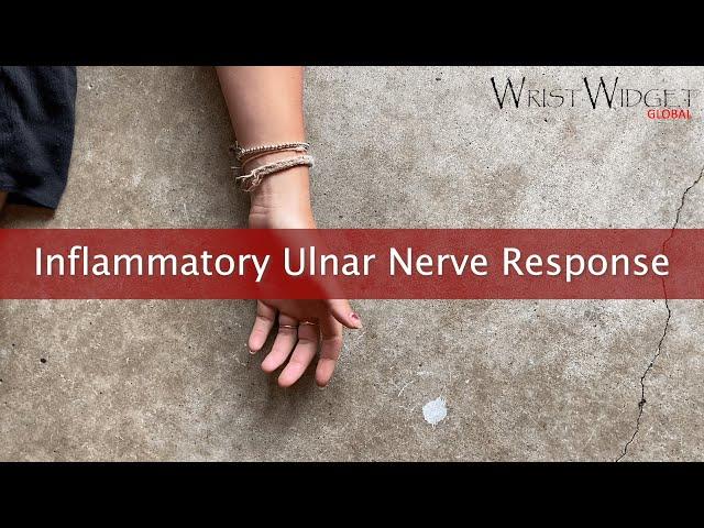 Inflammatory ulnar nerve response