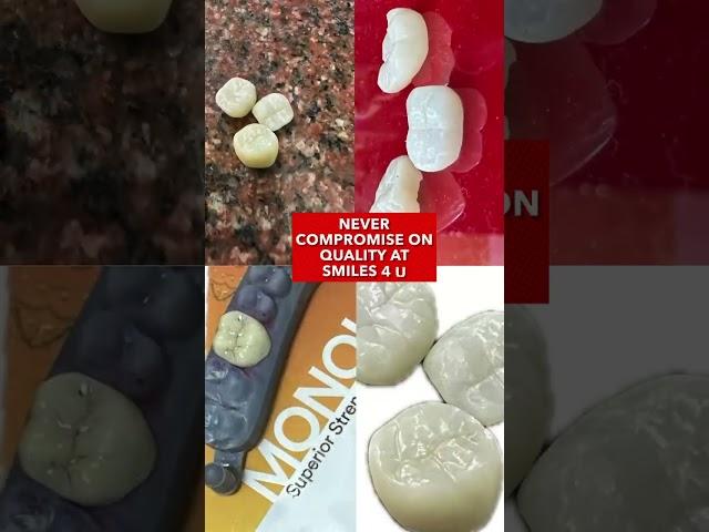 3M ceramic crown mix of aesthetic & strength #smile #cosmeticdentist #short#teeth