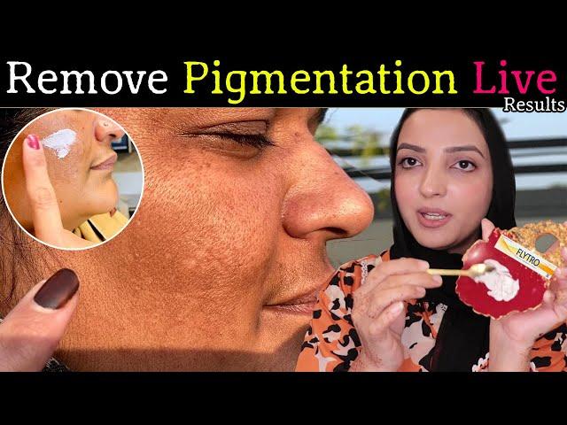 How I Removed Pigmentation of My Maid's Face? See Live Results by Memoona Muslima