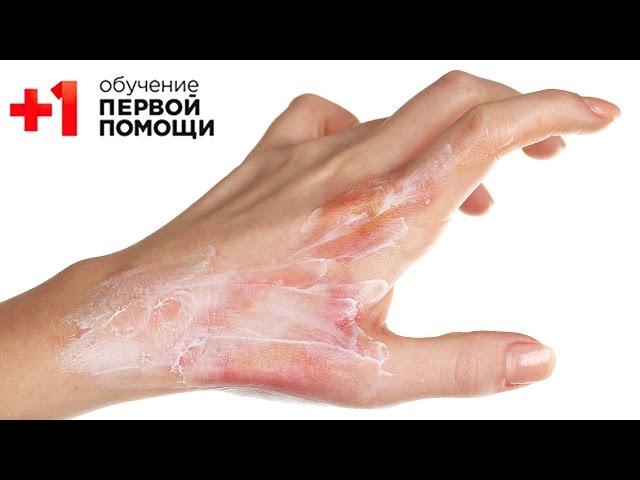 Ожоги || Правильная первая помощь при ожогах || Проект+1
