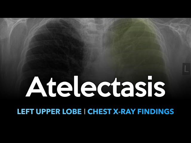 Atelectasis (Left Upper Lobe): Explanation of Chest X-ray Findings