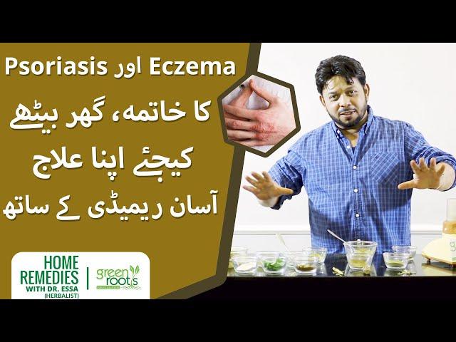 Eczema aur psoriasis ka khatma ghar bethay kijiye ilaj Dr Essa Herbalist ki remedy  | Green Roots
