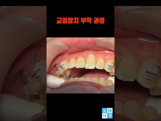 신기함주의 교정 장치 부착 과정 대공개