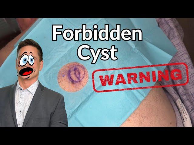 EXTREME Cyst Removal!