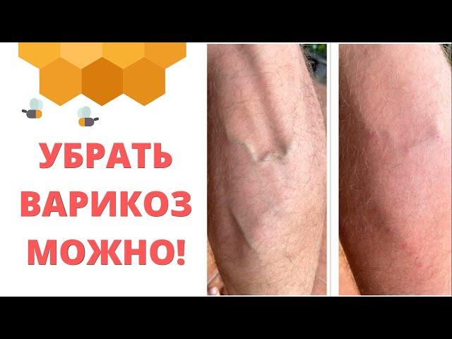 Варикозная болезнь причины и решения | Николай Мавричев
