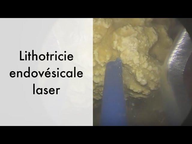 vaporization of several bladder stones then prostate enucleation laser