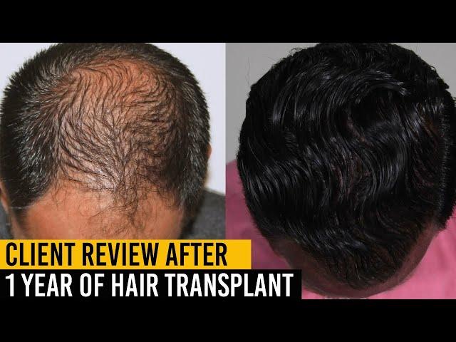 Client Review after 1 Year of Hair Transplant- Je Amour |  hair loss hair transplant results