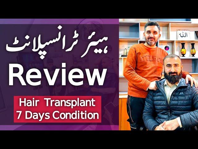 Hair Transplant SHOCKING Results! 7-Day Transformation | HONEST Review (Peshawar, Pakistan) | 2024