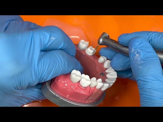 Adex full metal preparation bridge tooth #3