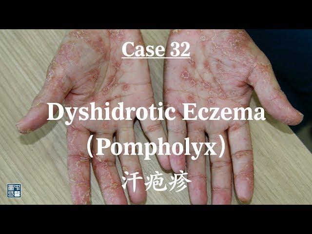 Dyshidrotic Eczema, Pompholyx,  汗疱疹