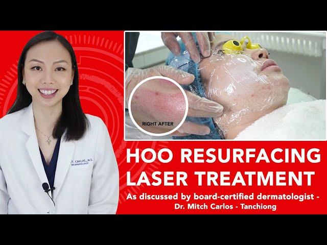 HOO RESURFACING LASER TREATMENT - FRACTIONAL CO2 LASER