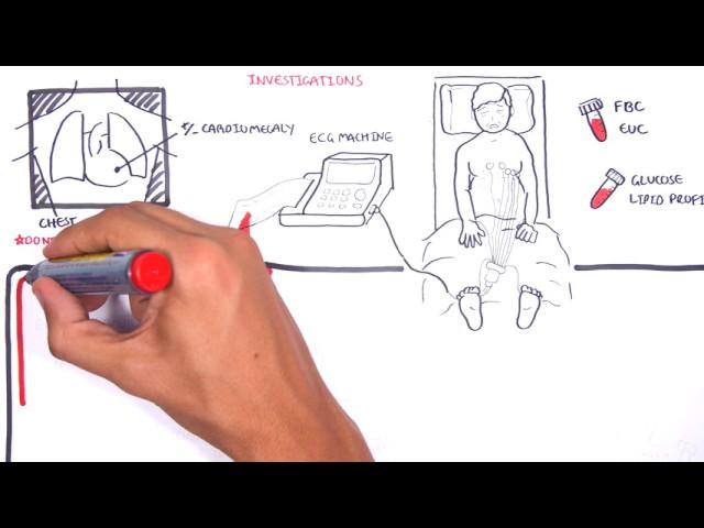 Acute Coronary Syndrome DETAILED Overview (MI, STEMI, NSTEMI)