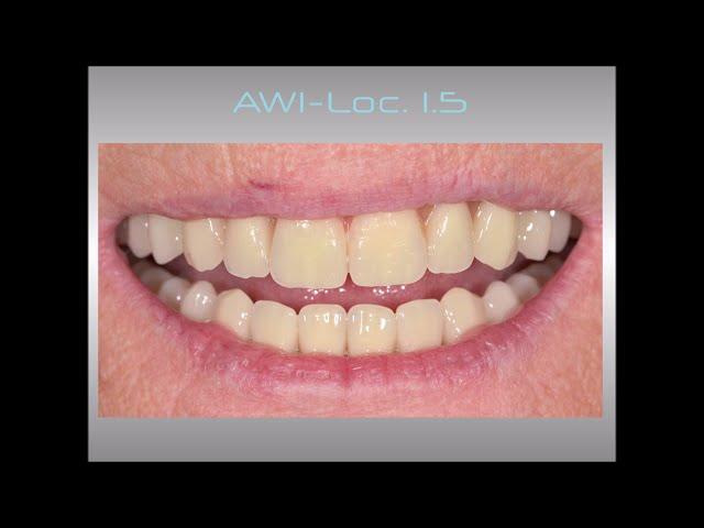 "AWI-Loc 1.5" UK. Totalprothese mit AWI Lokatoren.