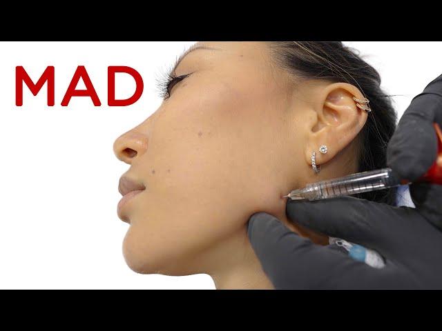 Why people get MAD after botox to masseters and how to FIX it | Masseter Atrophy Deformity | Newport