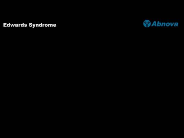 Edwards Syndrome