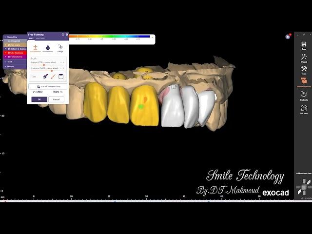 Free form 6 unit anterior teeth Dental design By Exocad