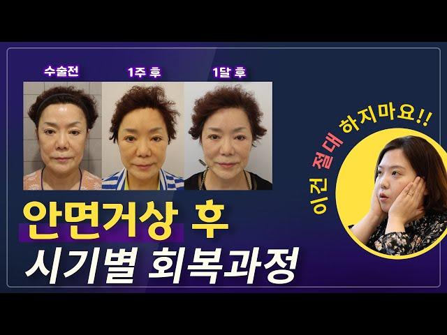 (Eng) 안면거상 후 시기별 회복과정 알려드립니다! The recovery phases of Midface Lifting!