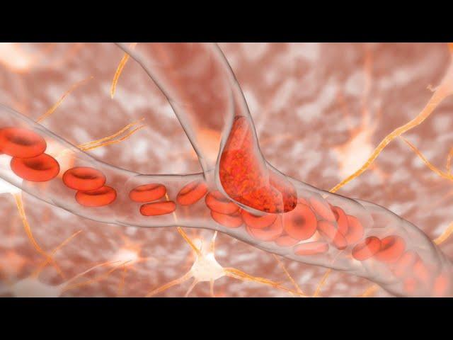 Ischemic Stroke