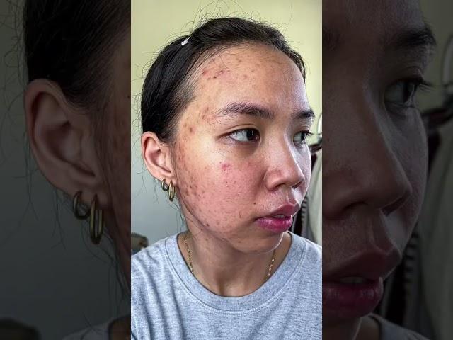 acne journey 🫶 #shorts #acne #acnejourney #acneproneskin #acnetreatment