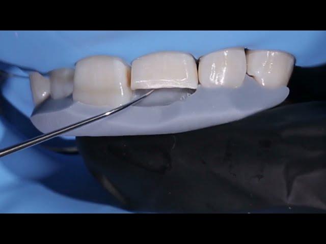 Anterior Direct Restoration. Zenit (President Dental) Dr.Samir Karimov