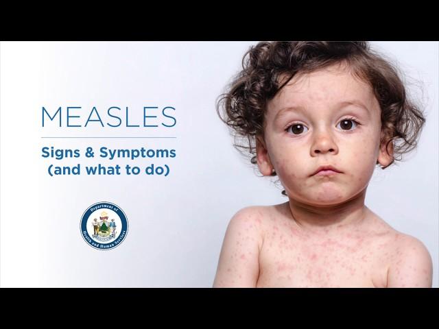 Measles Signs and Symptoms