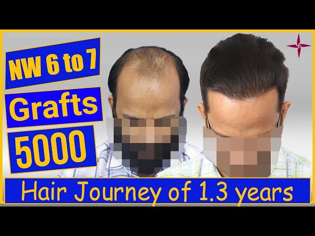 Hair Transplantation Result in 1.3 Years, 5000 Grafts, Grade 6 @Eugenix  by Drs Sethi & Bansal