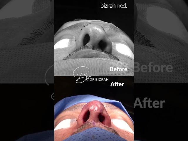 Nose Job Before And After : Dr. Bashar Bizrah/ London/Dubai