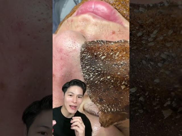 คลิปดูเพลิน ลอก #สิวเสี้ยน #สิว #สิวเรื้อรัง #สิวอุดตัน #สิวอักเสบ #กดสิว #ฝ้ากระ #รอยสิว #หลุมสิว
