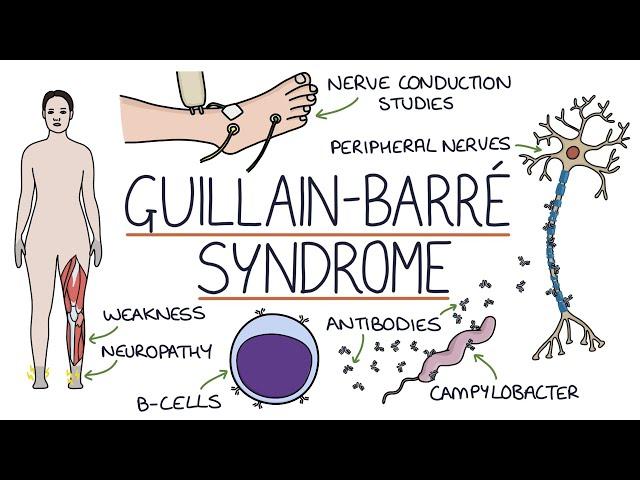 Understanding Guillain-Barré Syndrome