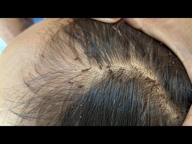 Remove many lice from brown hair - Plucking most of lice from head