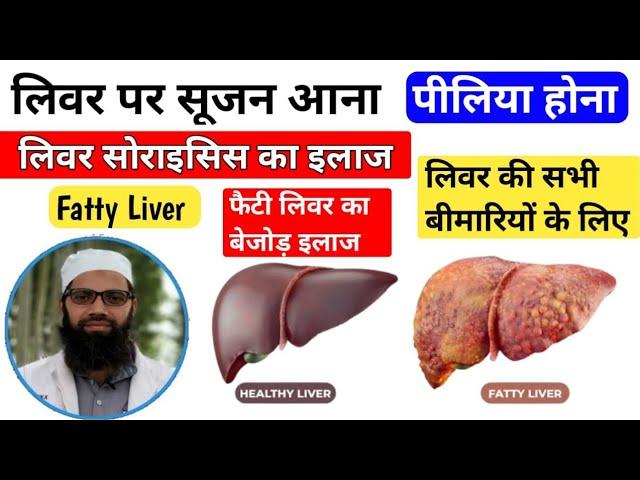 Fatty Liver ka Unani ilaaj | liver sirosis ka ayurvedic ilaaj |hepatitis ka Unani ilaaj | Unani Gyan