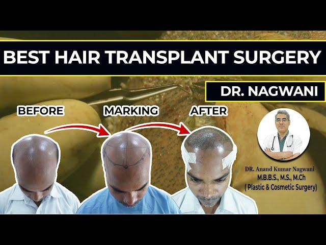 BEST HAIR TRANSPLANT IN KOLKATA | Cost & Result of Hair Transplant | Grade - 7 Baldness