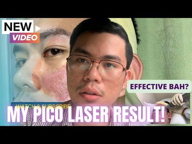 My Pico Laser Treatment Result - Before and After
