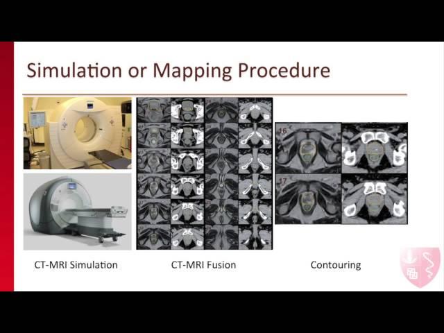 Stanford Radiation Oncologist Explains Radiation Therapy Treatment for Prostate Cancer