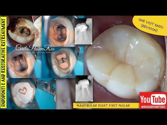 one visit endodontic one curve micro-mega rewalling composite resin perawatan saluran akar