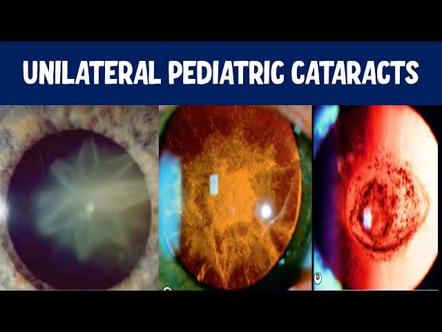 What causes childhood cataracts?