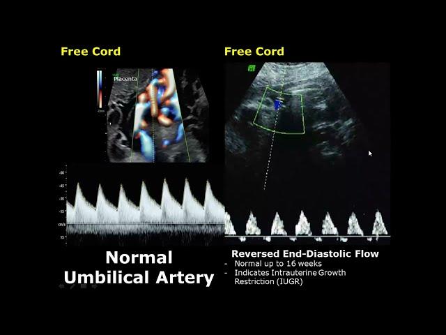 Umbilical Artery Doppler Ultrasound Normal Vs Abnormal Image Appearances | Spectral Doppler USG