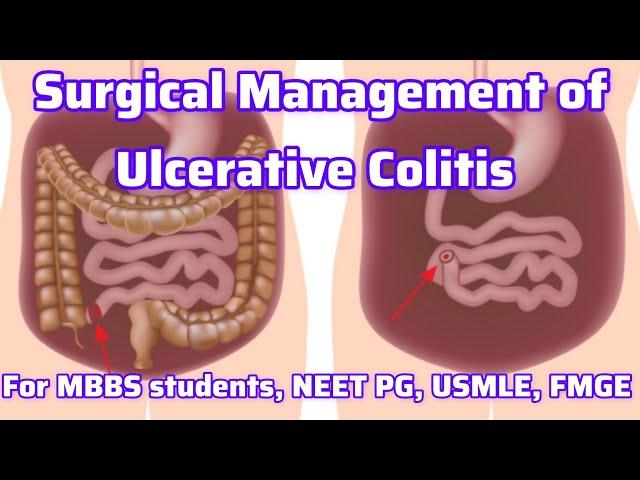 Surgical management of IBD For MBBS students, Neet PG, Usmle, FMGE I Neet PG Usmle Preparation