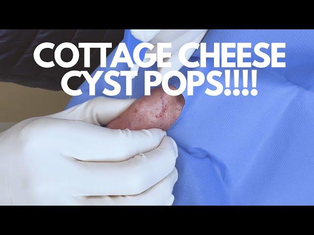 Ooey Gooey Nacho Cheese Cyst EXPLODES! | CONTOUR DERMATOLOGY