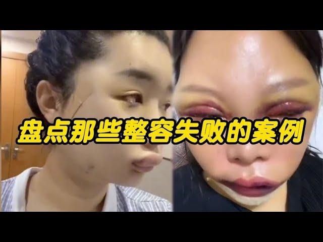 搞笑合集: 那些整容失败案例，小伙子一夜之间老了二十岁，悔不当初