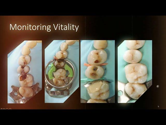 Restoration in the Posterior Dentition - Dentinal Tubules