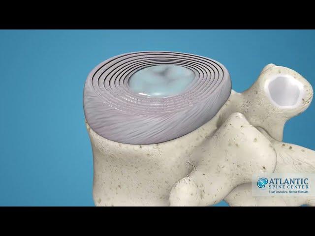 What is Cervical Disc Herniation? @AtlanticSpineCenter