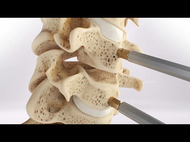 prodisc® C Surgical Technique Animation (2021) | Cervical Total Disc Replacement | Disc Arthroplasty