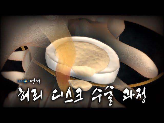 [명의 의학백과]  허리 디스크 수술 과정