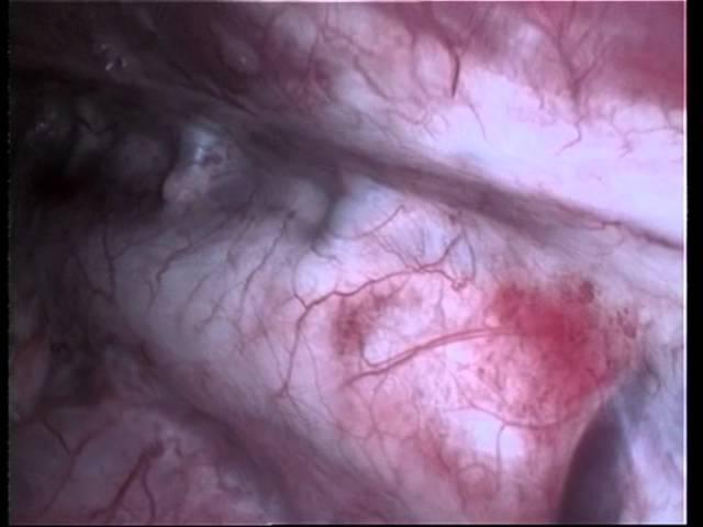 Foreign body in esophagus thoracoscopically , dog